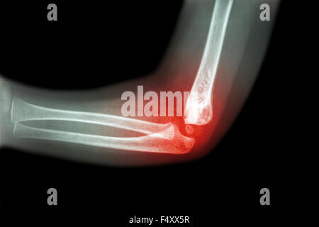 Rheumatoide Arthritis, Gicht-Arthritis (Film Röntgen Kind Ellenbogen mit Arthritis am Ellenbogen) (Seitenansicht, Lateral) Stockfoto