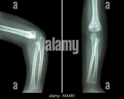 Roentgenfilm des Kindes Ellenbogen (normales Kind Ellenbogen) (seitlich und vorne, seitlich und anzeigen Anterior - Posterior-Ansicht) (2 postulieren Stockfoto