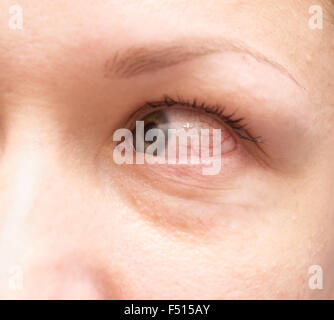 Nahaufnahme eines gereizten roten blutunterlaufenen Augen Stockfoto