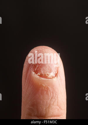 Die Hand eines erwachsenen männlichen mit einem fehlenden Fingernagel Stockfoto