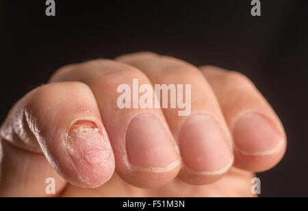 Die Hand eines erwachsenen männlichen mit einem fehlenden Fingernagel Stockfoto
