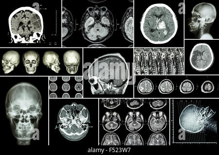 Satz, Sammlung von Erkrankung des Gehirns (Hirninfarkt, hämorrhagischer Schlaganfall, Gehirntumor, Bandscheibenvorfall mit Rückenmark co Stockfoto