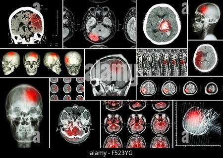 Satz, Sammlung von Erkrankung des Gehirns (Hirninfarkt, hämorrhagischer Schlaganfall, Gehirntumor, Bandscheibenvorfall mit Rückenmark co Stockfoto