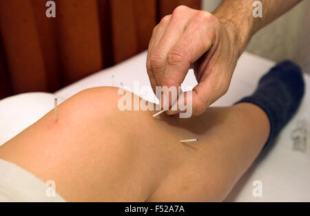 Arzt benutzt Akupunkturnadeln auf das Knie einer Frau Stockfoto