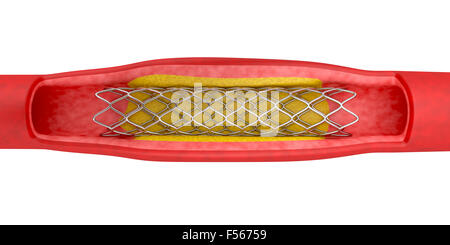 Angioplastie mit Stent Platzierung, 3d illustration Stockfoto