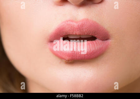 schöne Lippen-Virus infiziert-herpes Stockfoto