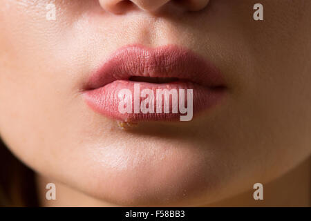 schöne Lippen-Virus infiziert-herpes Stockfoto