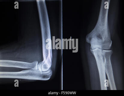 X-ray orthopädische medizinische CAT-Scan von schmerzhaften Tennis-Ellenbogen-Verletzung in Traumatologie Klinik. Stockfoto