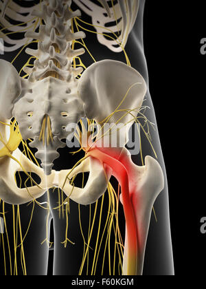 medizinisch genaue Abbildung - schmerzhafte Ischiasnerv Stockfoto