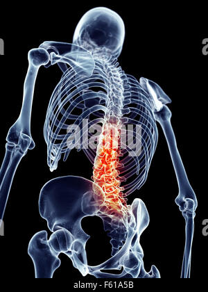 medizinisch genaue Abbildung - schmerzhafte Lendenwirbelsäule Stockfoto