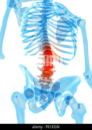 medizinisch genaue Abbildung - schmerzhafte Lendenwirbelsäule Stockfoto