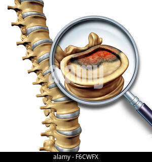 Wirbelsäule-Krebs und spinaler Tumor medizinische Krankheitskonzept als Skelett Wirbel mit einer Lupe Nahaufnahme von einer Vertabrate mit einem Krebsgeschwür. Stockfoto