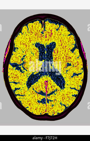 ZEREBRALE ATROPHIE, CT-SCAN Stockfoto