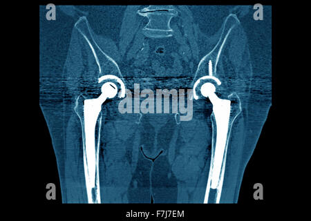 HÜFT-PROTHESE, CT-SCAN Stockfoto