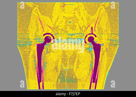 HÜFT-PROTHESE, CT-SCAN Stockfoto