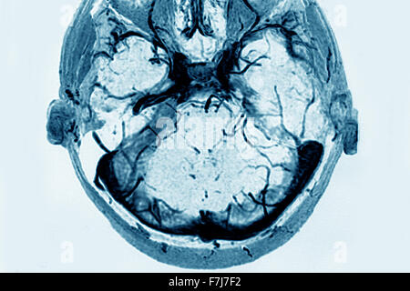 ZEREBRALE VENÖSE THROMBOSE Stockfoto