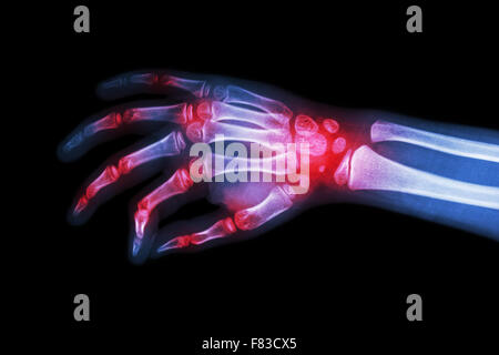 Rheumatoide Arthritis, Gicht-Arthritis (Film Röntgen Hand des Kindes mit Arthritis in mehreren gemeinsamen) Stockfoto