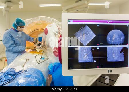 Patient erhält intervertebralen Scheibe Prothese Bandscheibenvorfall mit ROSA Spine® Robot, Amiens Krankenhaus behandeln Frankreich. Stockfoto