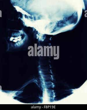 X-Ray Bild zeigt Schädel, Kiefer und Wirbelsäule Stockfoto