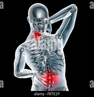 Röntgenbild eines Mannes mit Rückenschmerzen auf schwarz mit Beschneidungspfad. Stockfoto