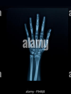 Röntgen-Hand Stockfoto