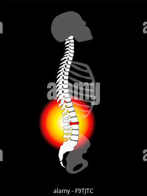 Schmerzen im Rücken - Wirbelsäule Bandscheibenvorfall oder Prolaps bei einer menschlichen Wirbelsäule - Höhenplan. Stockfoto
