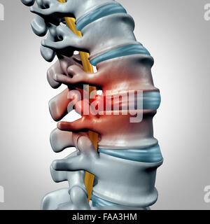 Bandscheibenvorfall-Konzept und Wirbelsäule Schmerzen Diagnose als ein Systemsymbol der menschlichen Wirbelsäule als medizinisches Problem und Anatomie-Symbol mit dem Skelett Knochen und Bandscheiben Closeup. Stockfoto