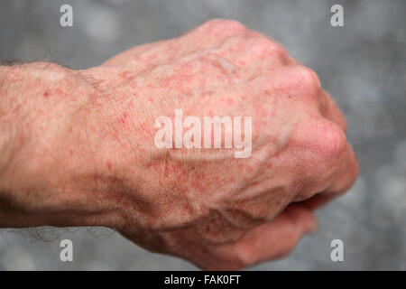 viele Mückenstiche auf der Rückseite der Hand nach einem Mücken Angriff in einem Wald auf der Iveragh-Halbinsel, County Kerry, Irland Stockfoto