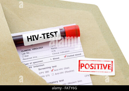 Blutprobe mit HIV-Test positiv und Labor Anfrageformular auf weißem Hintergrund. Stockfoto