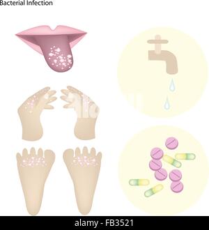 Medizinisches Konzept, Illustration der bakteriellen Infektion, Mund, Palm und Fuß mit einem Teil des Behandlungsprozesses. Stock Vektor