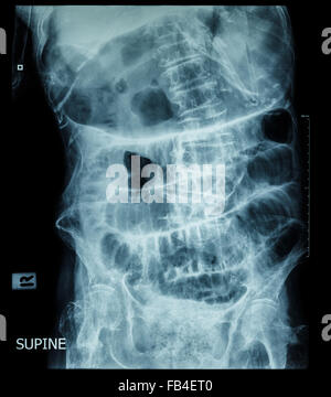 Kleinen Darmverschluss (Film Röntgen-Abdomen (Rückenlage): Show Dünndarm und Magen dehnen) (Leiter Schrittmuster) Stockfoto
