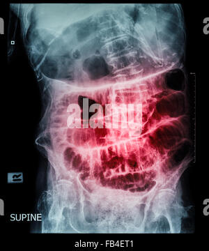 Kleinen Darmverschluss (Film Röntgen-Abdomen (Rückenlage): Show Dünndarm und Magen dehnen) (Leiter Schrittmuster) Stockfoto