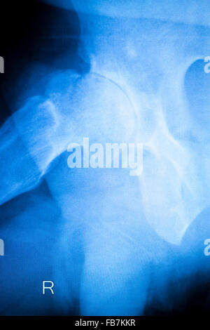 Arthritischen hip Xray Test Scan Orthopädie und Traumatologie Ergebnisse. Stockfoto