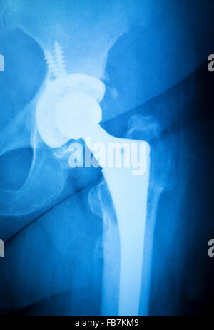 Arthritischen hip Xray Test Scan Orthopädie und Traumatologie Ergebnissen zeigt Titan Hüftgelenkersatz Platte und Schrauben chirurgisches Implantat. Stockfoto