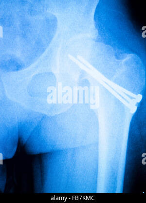 Arthritischen hip Xray Test Scan Orthopädie und Traumatologie Ergebnissen zeigt Titan Hüftgelenkersatz Platte und Schrauben chirurgisches Implantat. Stockfoto