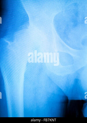 Arthritischen hip Xray Test Scan Orthopädie und Traumatologie Ergebnisse. Stockfoto