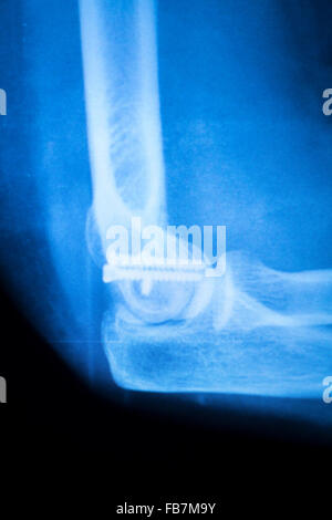 Othopedics und Unfallchirurgie chirurgische Implantat Arm und Ellenbogen Xray Scan Testergebnisse zeigen Metall Titanplatte und Schrauben. Stockfoto