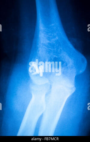 Othopedics und Unfallchirurgie chirurgische Implantat Arm und Ellenbogen Xray Scan Testergebnisse zeigen Metall Titanplatte und Schrauben. Stockfoto