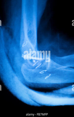 Othopedics und Unfallchirurgie chirurgische Implantat Arm und Ellenbogen Xray Scan Testergebnisse zeigen Metall Titanplatte und Schrauben. Stockfoto