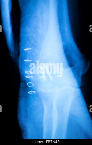 Othopedics und Unfallchirurgie chirurgische Implantat Arm und Ellenbogen Xray Scan Testergebnisse zeigen Metall Titanplatte und Schrauben. Stockfoto