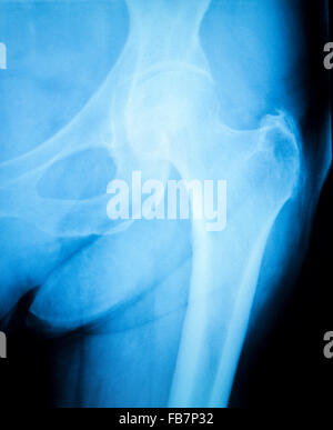 Arthritischen hip Xray Test Scan Orthopädie und Traumatologie Ergebnisse. Stockfoto