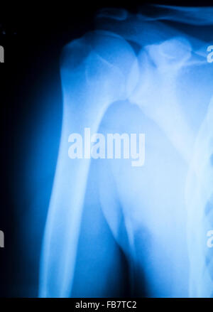 Arthritischen hip Xray Test Scan Orthopädie und Traumatologie Ergebnisse. Stockfoto