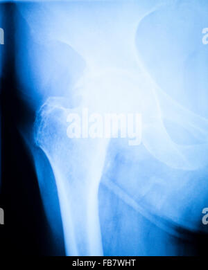 Arthritischen hip Xray Test Scan Orthopädie und Traumatologie Ergebnisse. Stockfoto