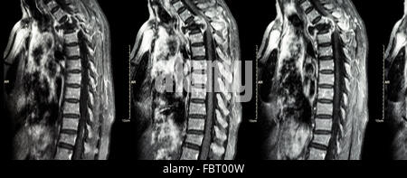 Wirbelsäule Metastasen (Krebs zu verbreiten, Brustwirbelsäule) (MRI des zervikalen und thorakalen Wirbelsäule: Brustwirbelsäule Metastasierung und c zeigen Stockfoto