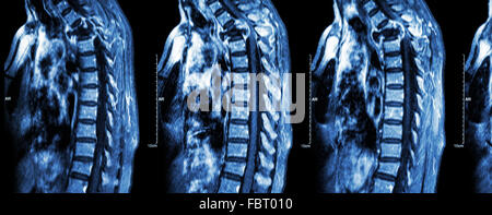 Wirbelsäule Metastasen (Krebs zu verbreiten, Brustwirbelsäule) (MRI des zervikalen und thorakalen Wirbelsäule: Brustwirbelsäule Metastasierung und c zeigen Stockfoto