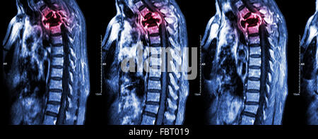 Wirbelsäule Metastasen (Krebs zu verbreiten, Brustwirbelsäule) (MRI des zervikalen und thorakalen Wirbelsäule: Brustwirbelsäule Metastasierung und c zeigen Stockfoto