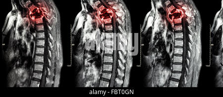Wirbelsäule Metastasen (Krebs zu verbreiten, Brustwirbelsäule) (MRI des zervikalen und thorakalen Wirbelsäule: Brustwirbelsäule Metastasierung und c zeigen Stockfoto