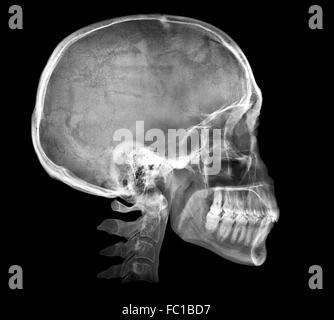 Menschlicher Schädel Röntgenbild Stockfoto