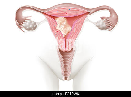 ENDOMETRIUMKARZINOM, ZEICHNUNG Stockfoto