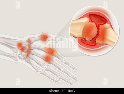 RHEUMATOIDE ARTHRITIS, ZEICHNUNG Stockfoto